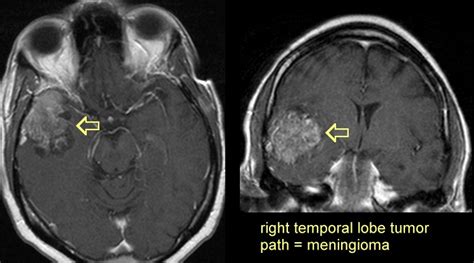 Meningioma Images