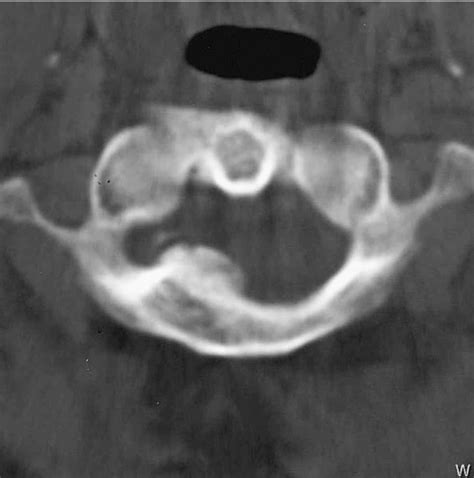 Bone Window Axial Computed Tomography Scan At The Level Of C1 2 Showing Download Scientific