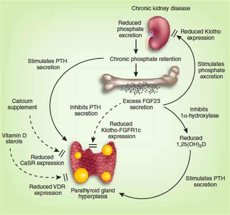 Hyperparathyroidism In Chronic Kidney Disease Endotext NCBI 45 OFF