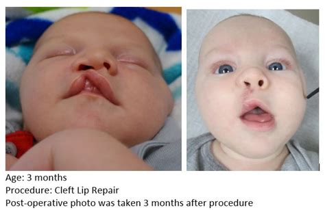 Cleft Lip Repair Uf Health Plastic Surgery And Aesthetics Center Uf