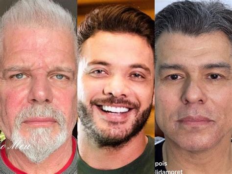 Harmoniza O Facial Em Homens Veja O Antes E Depois De Famosos