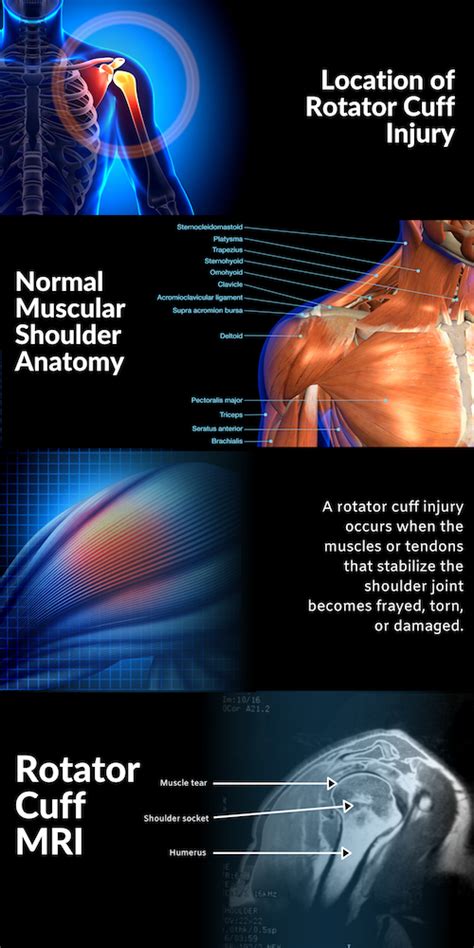 Average Rotator Cuff Settlement Compensation In 2023