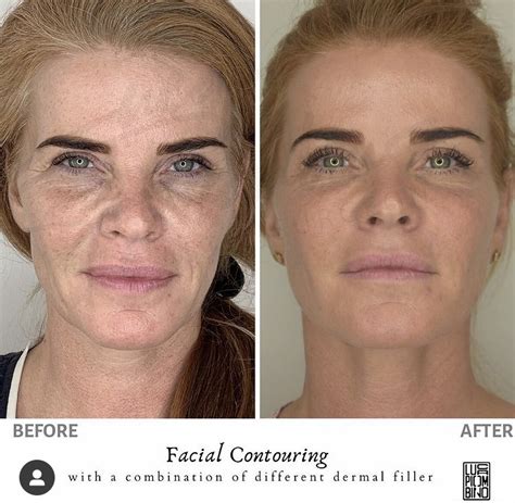 Face Contouring Ringiovanire Il Viso Senza Bisturi Luca Piombino