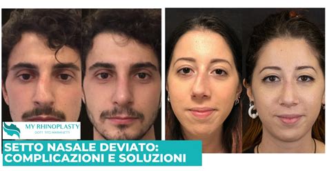 Setto Nasale Deviato Cover My Rhinoplasty