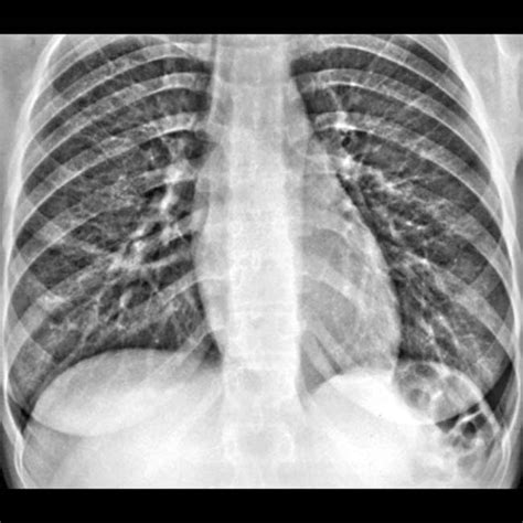 Esophageal Achalasia | Radiology Key