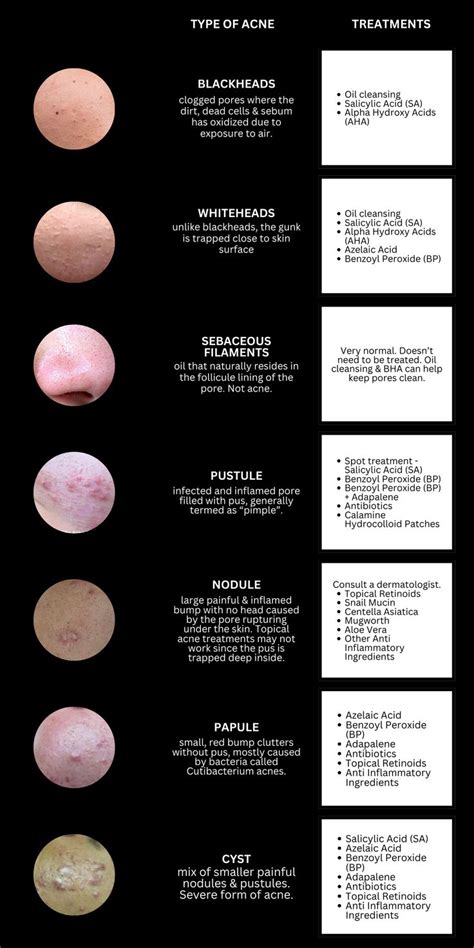 Types of acne #acne #skincare #blackheads #treatments | Skin advice ...