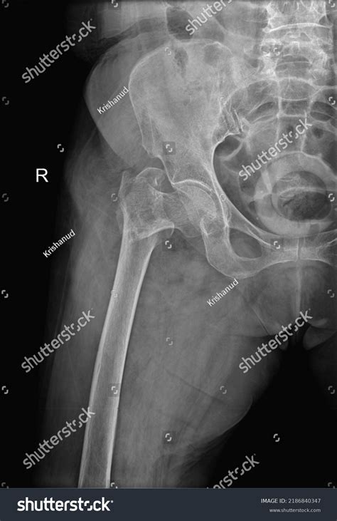 Xray Hip Joint Fracture Ap Radiograph Stock Photo 2186840347 | Shutterstock