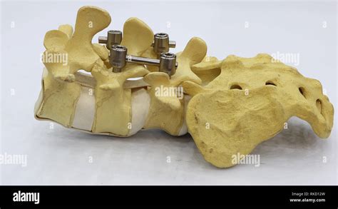 fixation system  res stock photography  images alamy