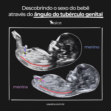 Como descobrir o sexo do bebê através do tubérculo genital