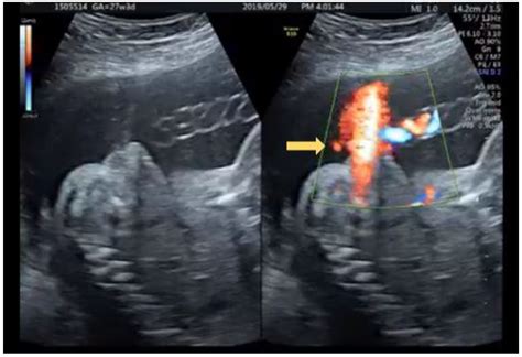 Ultrasonographic Diagnosis Of Fetal Hypospadias