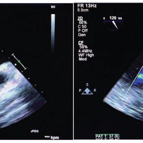 A The Follow Up Transthoracic Echocardiogram Showing Small Calcified