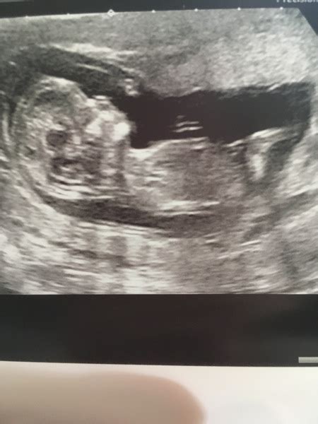 Can Anyone Guess The Gender From 12 Week Scan Mumsnet