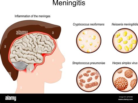 Meningitis Cerebro humano con inflamación de las meninges Patógenos