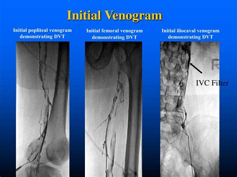 Ppt Deep Vein Thrombosis Powerpoint Presentation Free Download Id 822146