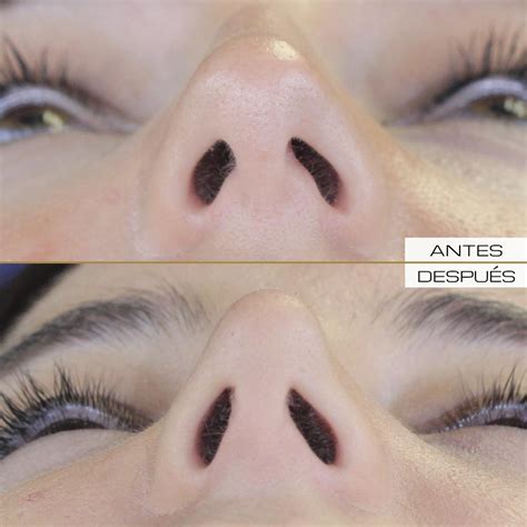 Rinoplastia Cerrada Dr Ramón Terré