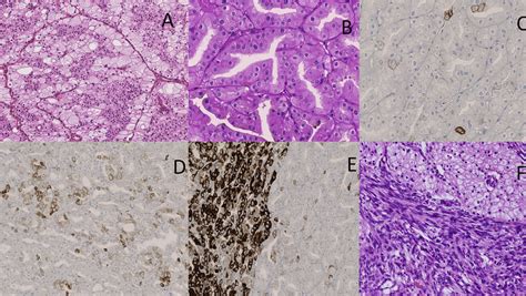 Morphological Heterogeneity Of Chromophobe Renal Cell Carcinoma Rcc