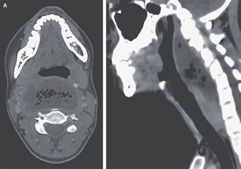 Retropharyngeal Abscess Medizzy