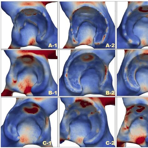 Comparison Of Von Mises Stress Distributions Of Facies Lunata At