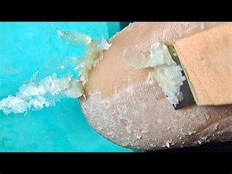 Satisfying Foot Callus Removal Like Pieces Of Cheese And Skin Cleaning
