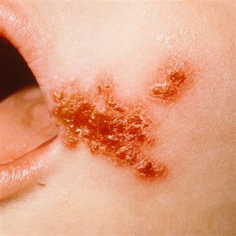 Bullous Impetigo Symptoms Causes Diagnosis Prevention Diseases Lab