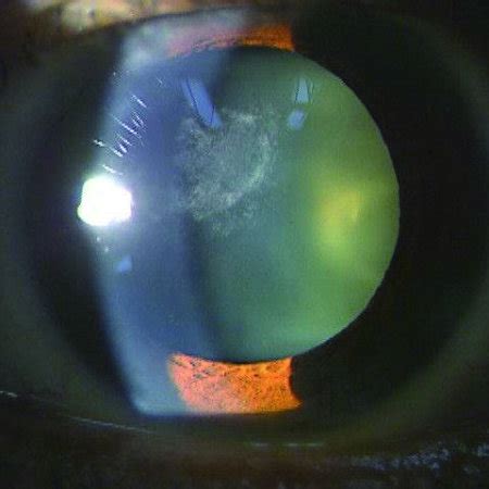 Preoperative slit-lamp examination disclosed a marked anterior ...