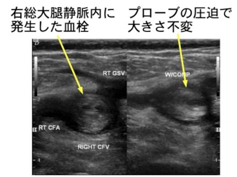 深部静脈血栓症の症状・診断・治療 骨・筋肉・関節の病気 All About