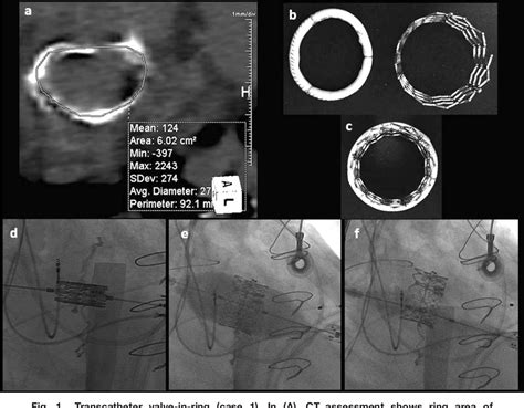 Figure 1 From VALVULAR AND STRUCTURAL HEART DISEASES Case Report