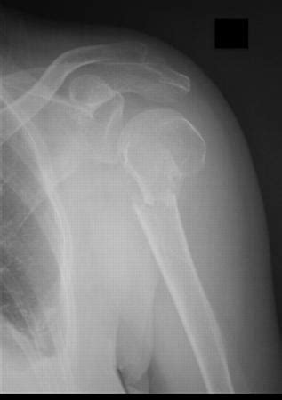 Humerus Surgical Neck Fracture