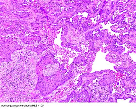 Pathology Outlines Adenosquamous Carcinoma