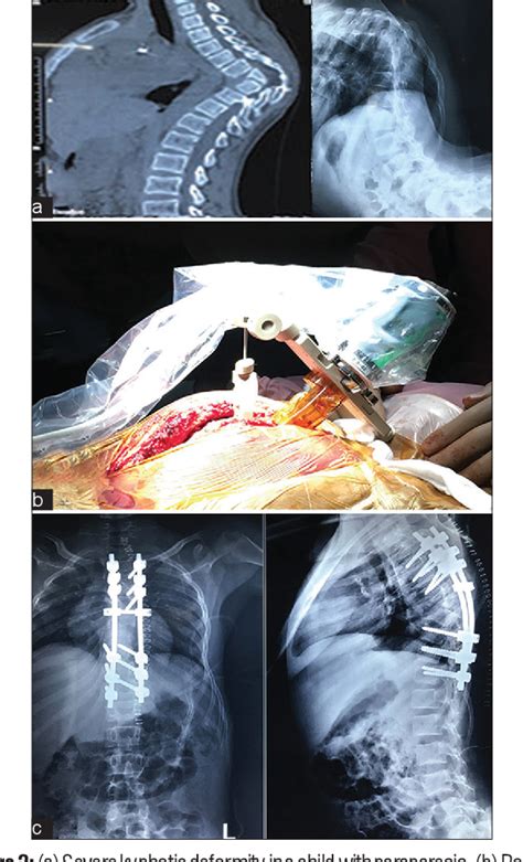 From Plaster Beds To Robotics Evolution Of Spine Surgery In India