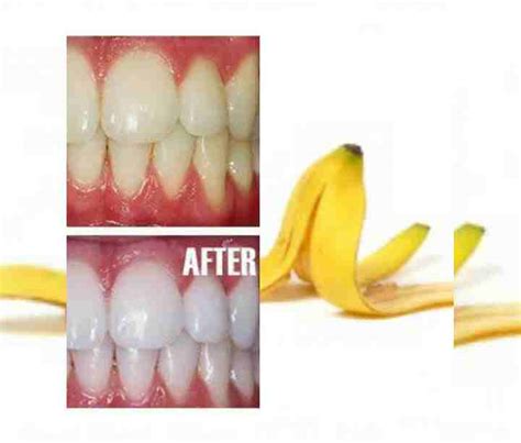 6 proven ways to whitening teeth with banana peel | Health soothe