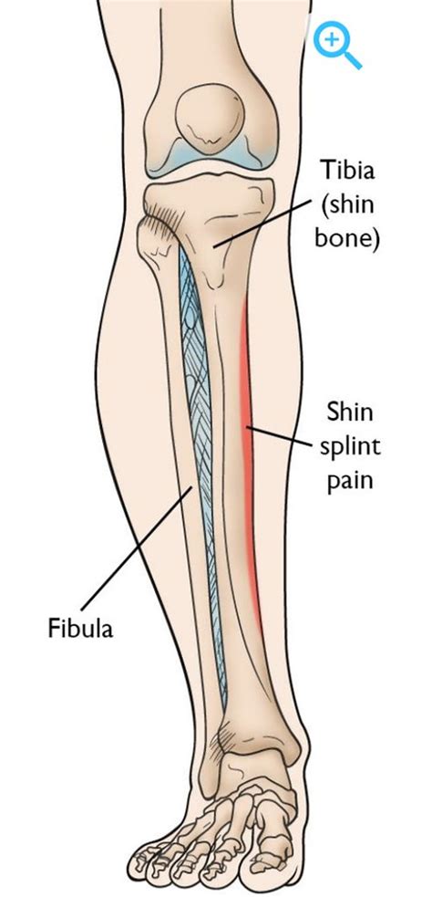 Tendinitis Del Tibial Anterior