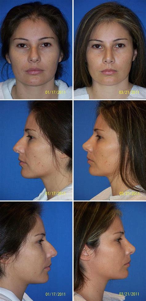 Rhinoplasty Nose Surgery Before And After Photos Miami Plastic Surgery