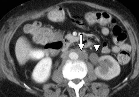 Retroperitoneal Fibrosis A Review Of Clinical Features And Imaging