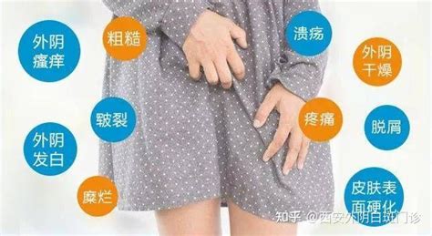 女性外阴瘙痒伴口腔粘膜症状是怎么回事？ 知乎