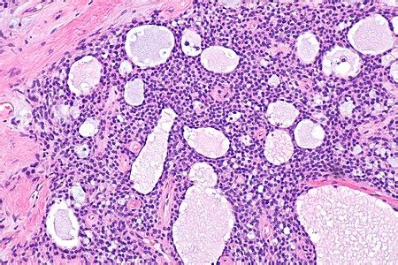 Ovarian Microcystic Stromal Tumour Libre Pathology