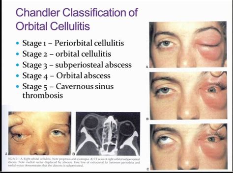 Preseptal And Orbital Cellulitis Flashcards Quizlet