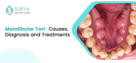 Mandibular Tori : Causes, Diagnosis and Treatments