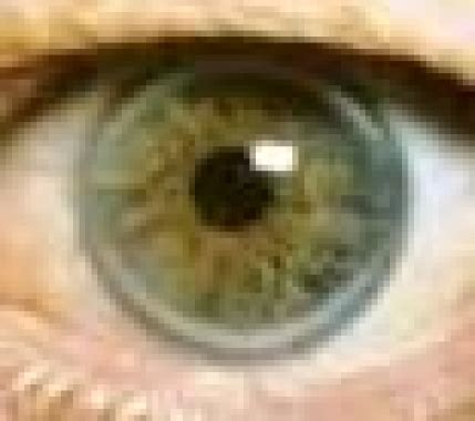 iris  window   genetics  common  rare eye diseases pmc