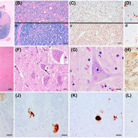 frequent copathologies  als ac segmental hippocampal sclerosis