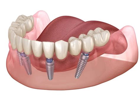 What Are Clear Choice® Dental Implants? - parkplazadentalcare.com