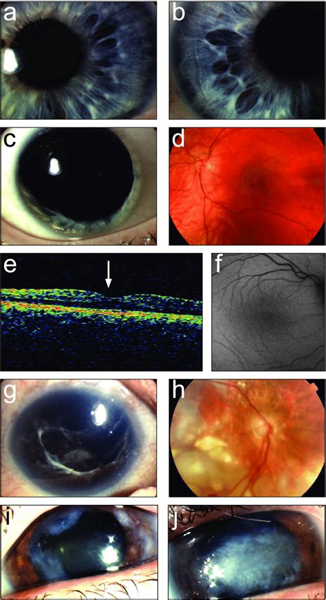 A D Ocular Anomalies In A Mother And Daughter With The PAX6 Missense