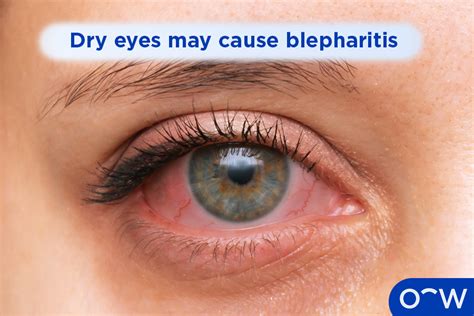 Blepharitis Types Causes Symptoms Diagnosis And Treatments