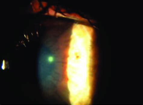 Silt Lamp Examination Revealed A Central Corneal Ulcer X Mm