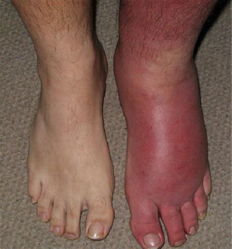 Cellulitis Infection Foot