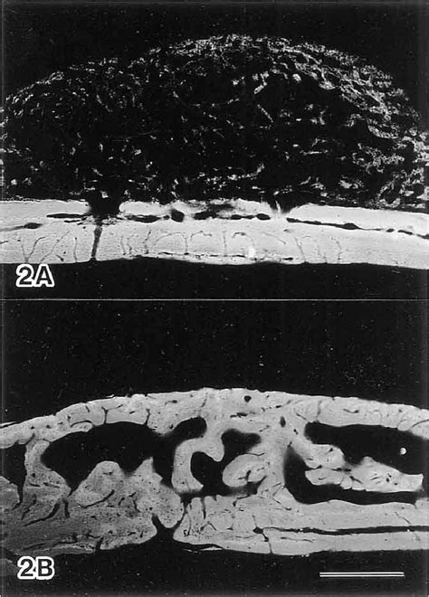 Contact Radiomicrographs Of Calvaria After Implantation Of Rhbmp With