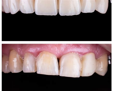 5 Great Tips To Look After Your Porcelain Veneers To Keep It Clean