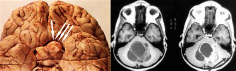 Neoplasms Of The Nervous System Flashcards Quizlet