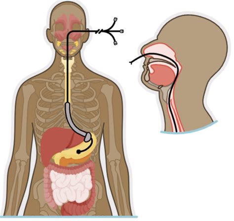 Ch Nasogastric Intubation And Enteral Feedings Flashcards Quizlet