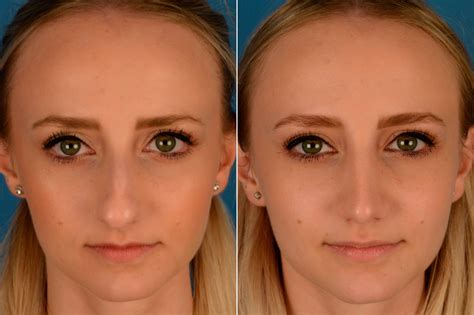 Rhinoplasty Photos Aesthetic Surgery Center